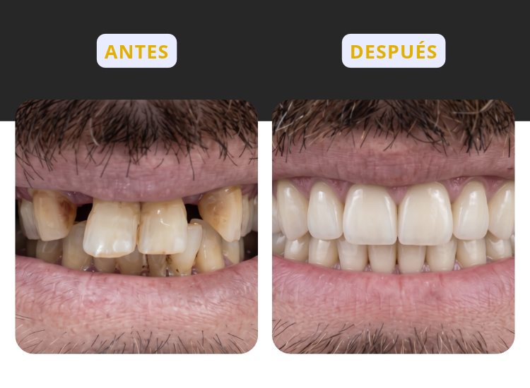 Corona de zirconio sobre un diente