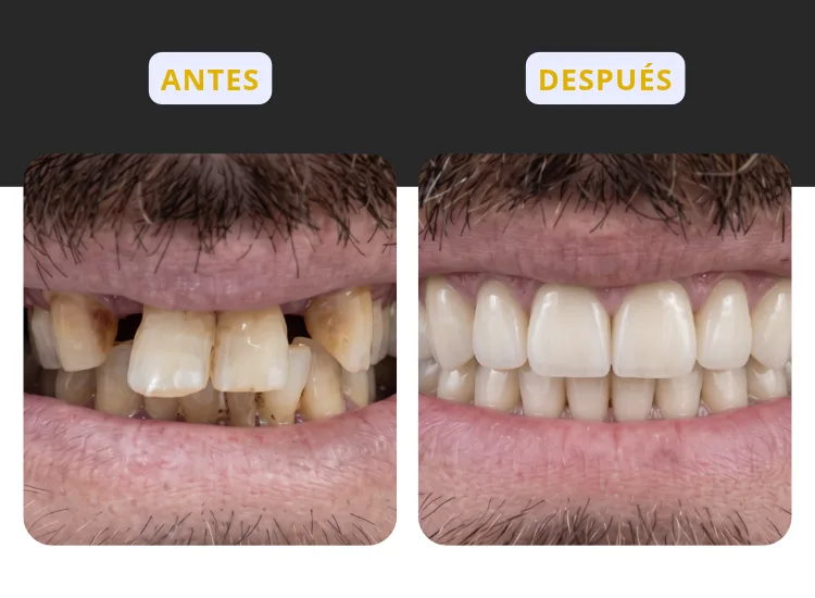 Corona de zirconio sobre un diente