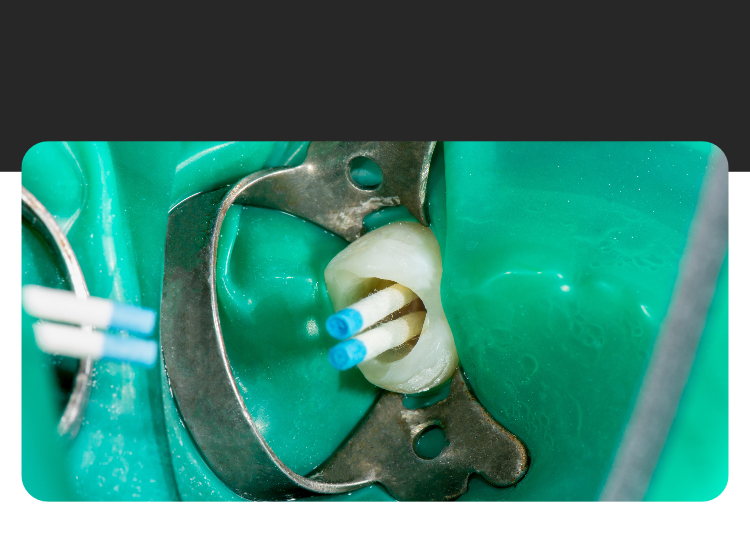 Tratamiento de endodoncia para salvar un diente