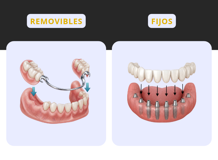 Prótesis dental para recuperar los dientes perdidos